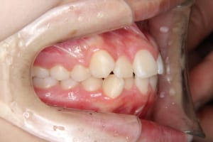 前歯の叢生、唇側傾斜が認められます